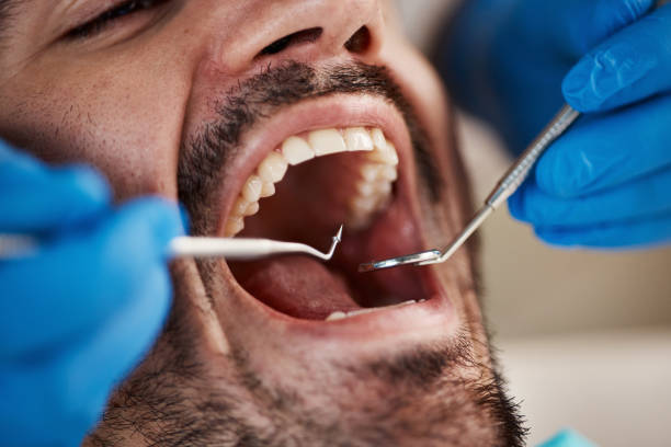 Best Emergency Treatment for Dental Infections or Abscesses in Rancho Santa Margarita, CA